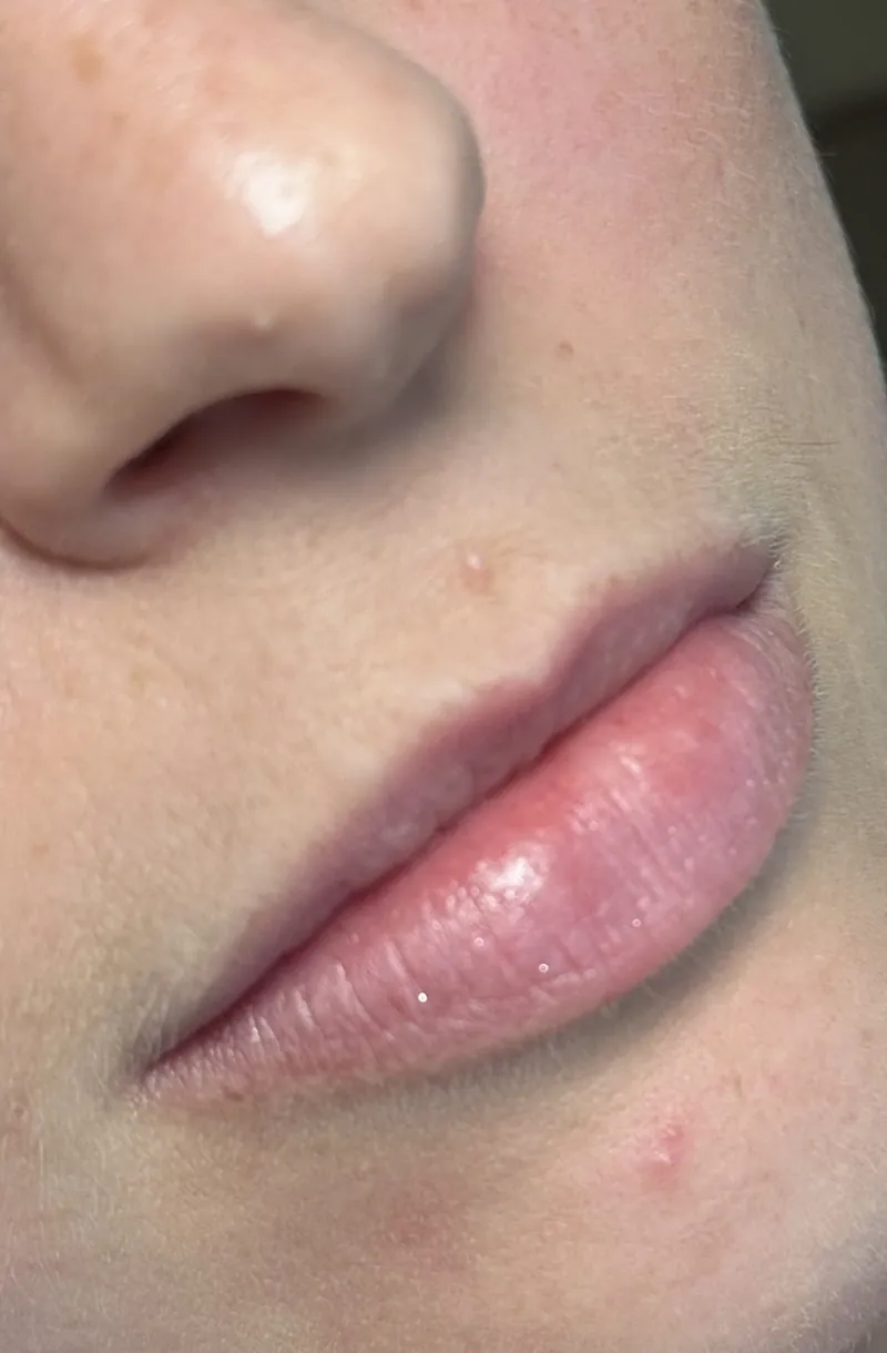 Antes do preenchimento labial